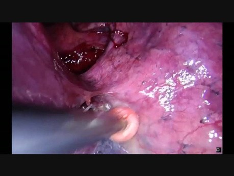 Double Sleeve Uniportal Video-Assisted Thoracoscopic Lobectomy