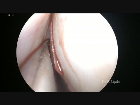 Pansinusitis + Septo-Turbinoplasty