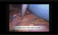 Gastric Bypass Procedure in a Bariatric Case of a Patient with a Total Situs Inversus
