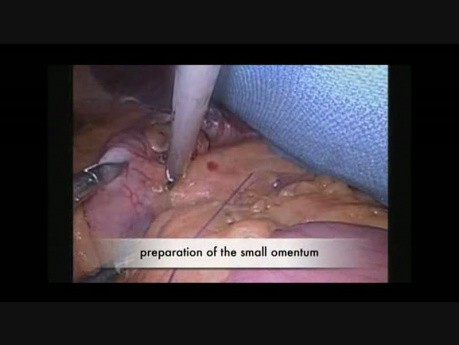 Gastric Bypass Procedure in a Bariatric Case of a Patient with a Total Situs Inversus