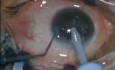 Cataract Surgery - Phacoemulsification 