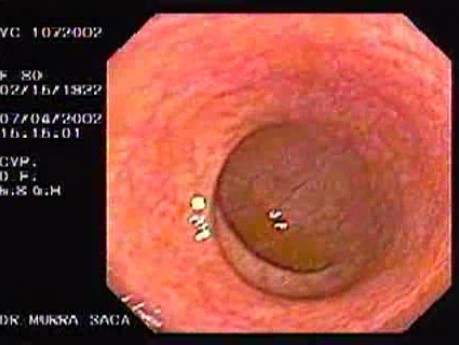 Post-Radiation Colitis (1 of 4)