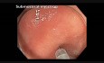 Colonoscopy Channel - Identification of a Subtle Flat Lesion in the Cecum