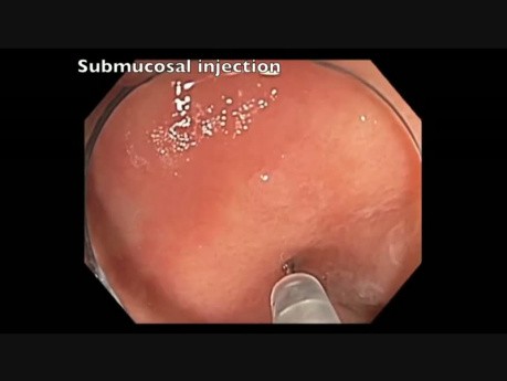 Colonoscopy Channel - Identification of a Subtle Flat Lesion in the Cecum