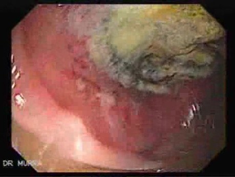 Non - Hodgkin's Lymphoma Of The Colon (4 of 16)