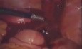 Ectopic Tubal Pregnancy