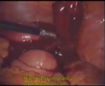 Ectopic Tubal Pregnancy