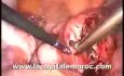 Laparoscopic Polymyomectomy (Bicornuate Uterus)