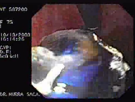 Dilatation of Achalasia by Use Of the Balloon with Water Insufflation