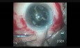 Oval Rhexis Helps in Removing Black Cataract