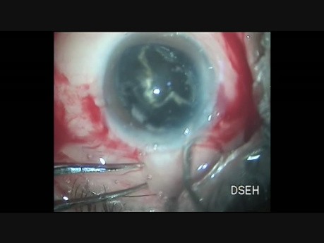 Oval Rhexis Helps in Removing Black Cataract