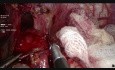 Lap Hellers Cardiomyotomy for Achalasia Cardia