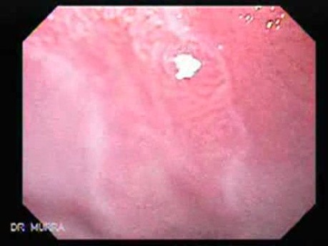 Endoscopic view of Barrett Esophagus (1 of 9)