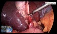 Safe Way of Performing Laparoscopic Cholecystectomy