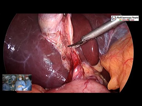 Safe Way of Performing Laparoscopic Cholecystectomy