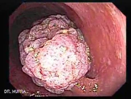 Large Tubulo-Villous Adenoma (6 of 6)