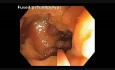 Pseudopolyposis In Patient with Iflammatory Bowel Disease: Polyps In Cecum And Ascending Colon