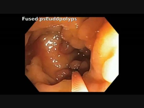 Pseudopolyposis In Patient with Iflammatory Bowel Disease: Polyps In Cecum And Ascending Colon