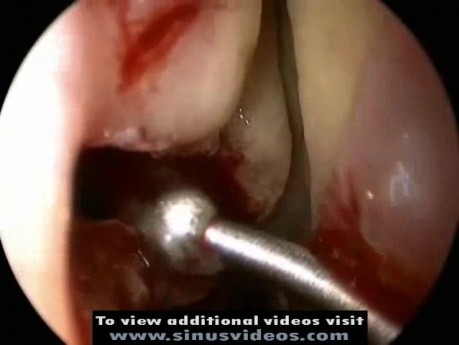Microdebrider Uncinectomy