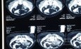 Appendicular Abscess CT 1