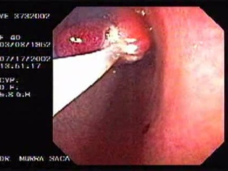 Polypectomy (5 of 6)