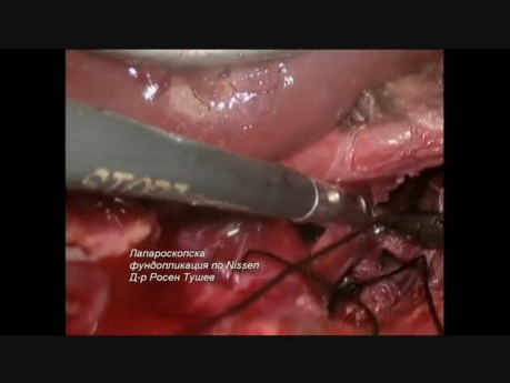 Laparoscopic Nissen Fundoplication (GERD)
