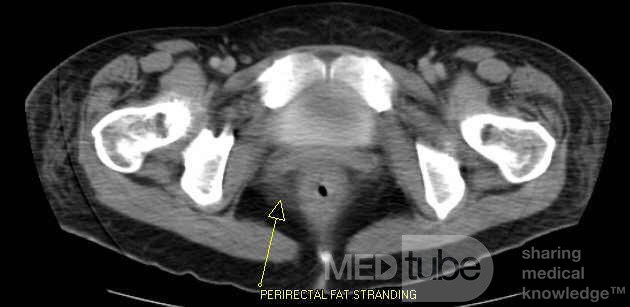 Multiple Rectal Ulcers (46of 110)
