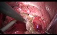 Laparoscopic Resection of Bladder Endometriosis (JMIG)