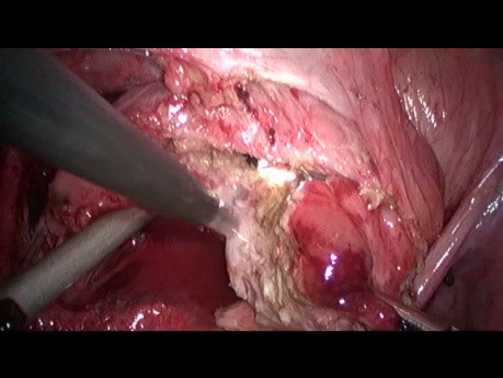 Laparoscopic Resection of Bladder Endometriosis (JMIG)