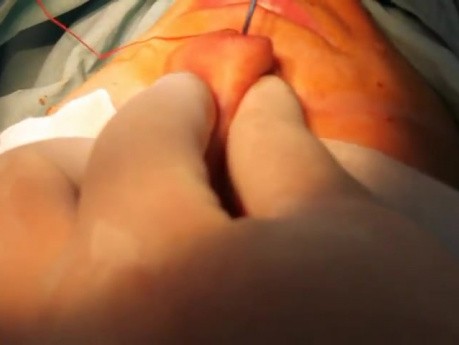 Tip rotation after hump removal