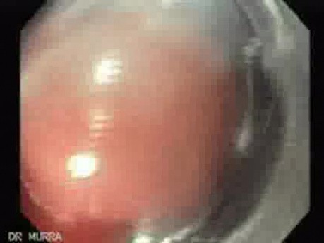 Bleeding Due to Dieulafoy´s Lesion (5 of 8)