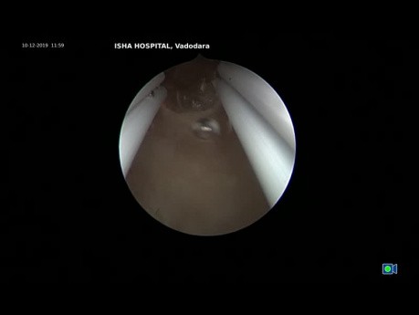 Hysteroscopic Resection Senile Polyp