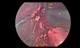 Gastro-jejunal Anastomosis Redo in a RYGB
