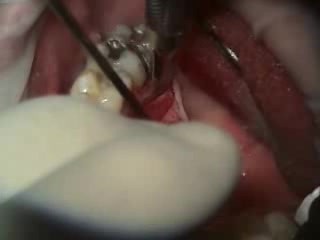 How To Cover Recession Caused By Tongue Piercing