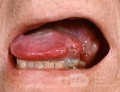 Squamous Cell Carcinoma of the Tongue