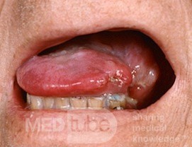 Squamous Cell Carcinoma of the Tongue