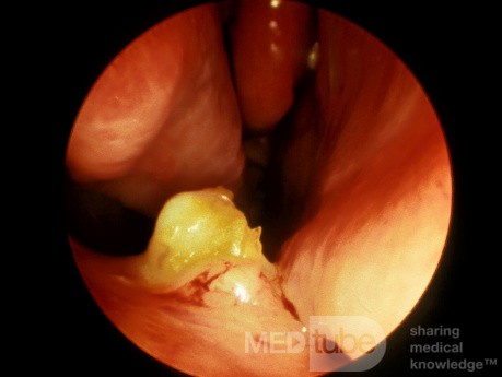 Tooth Projecting through Floor of the Nasal Cavity