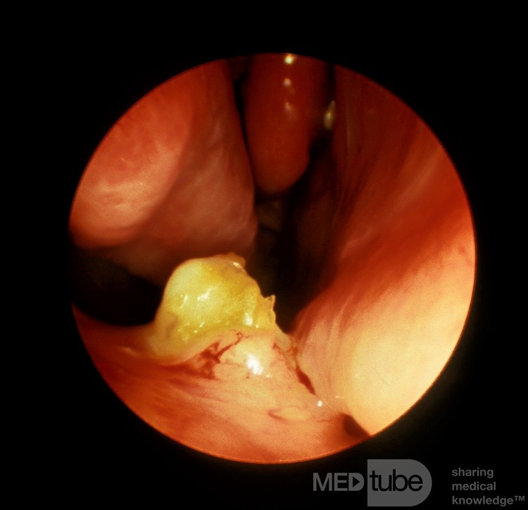 Tooth Projecting through Floor of the Nasal Cavity