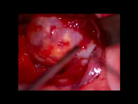 Giant-Aneurysms