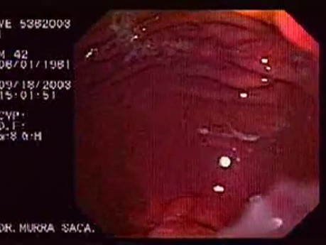 Pseudo Achalasia (2 of 4)