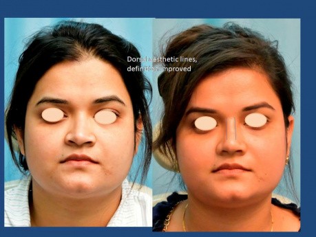 Finesse Rhinoplasty