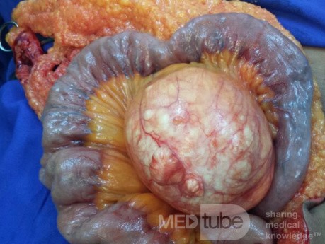 Mesenteric Cyst