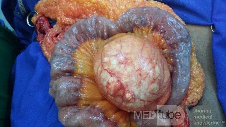 Mesenteric Cyst