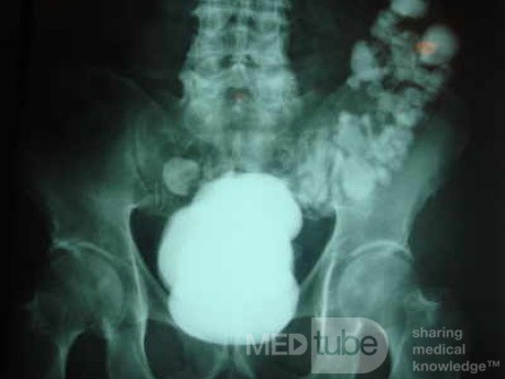 Sigmoid Diverticulitis - Colovesical Fistula (2 of 8)