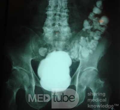 Sigmoid Diverticulitis - Colovesical Fistula (2 of 8)