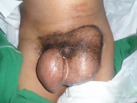 Bilateral Inguinal Hernia   