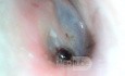 Tick Adherent to TM