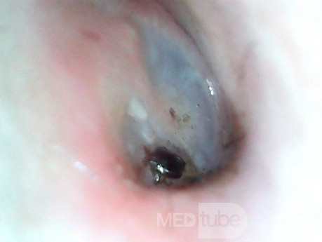 Tick Adherent to TM