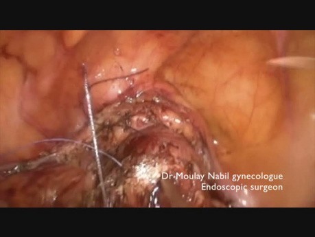 Isthmocele. Laparoscopy After Failure of Hysteroscopic Treatment