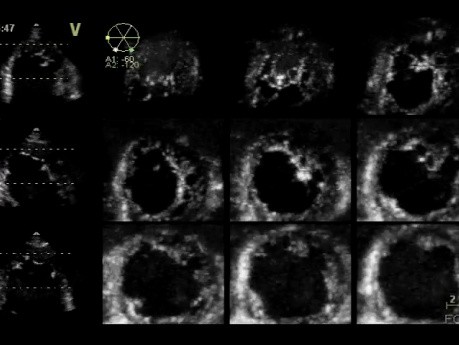 Left Ventricular Noncompaction in 3D Echocardiography, Video nr 1